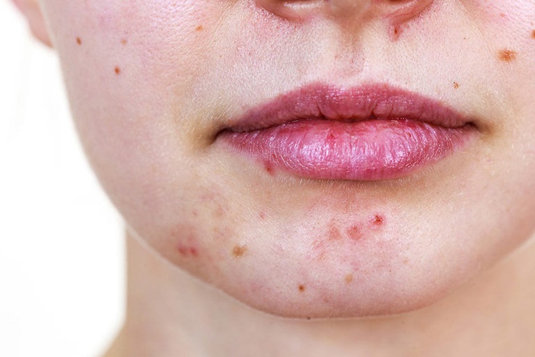 kem trị mụn trứng cá