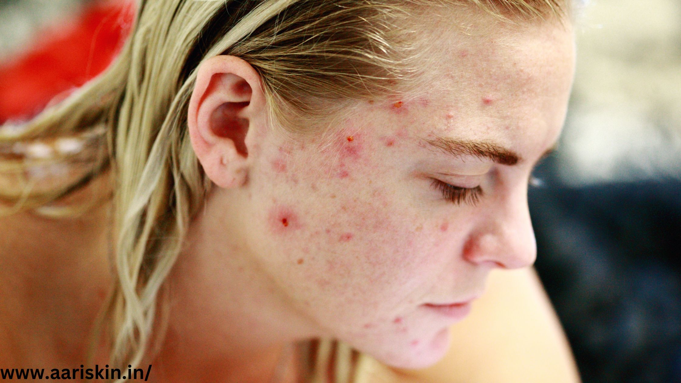 best acne treatment in Jaipur