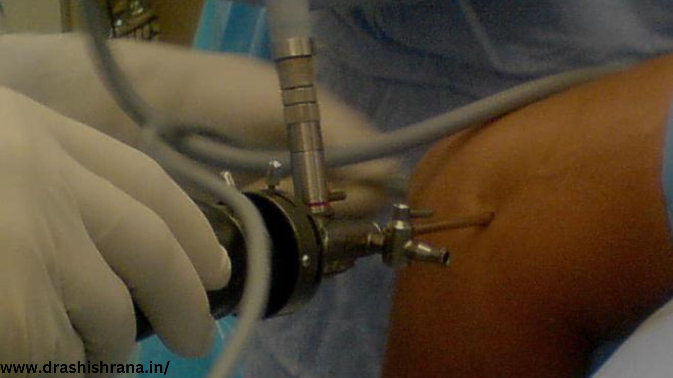 Elbow Arthroscopy Surgeon In Jaipur
