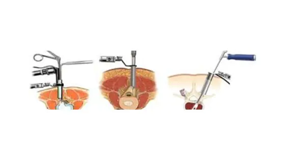 Kolkata's Top Spine Surgeons: Expertise in Minimal Access Spine Surgery for Optimal Results
