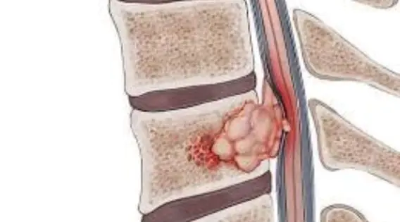 Spine Tumors in Kolkata: Symptoms, Diagnosis and Treatment Options