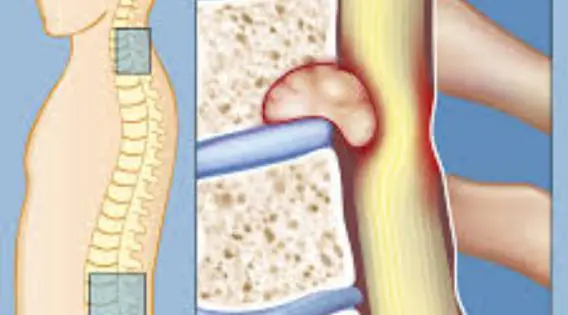 Spine Tumor Diagnosis and Treatment in Kolkata: A Comprehensive Guide