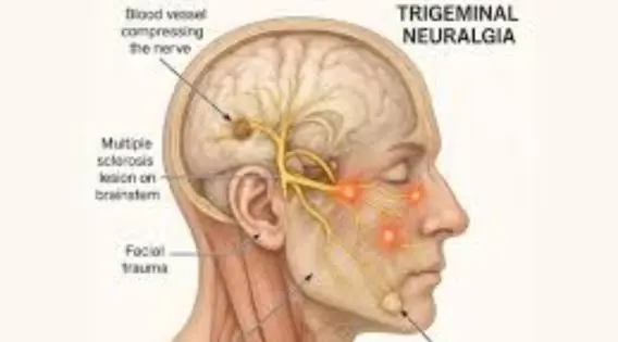 A Patient Journey for Living a Normal Life with Trigeminal Neuralgia - Best Trigeminal Neuralgia Specialist Kolkata, India
