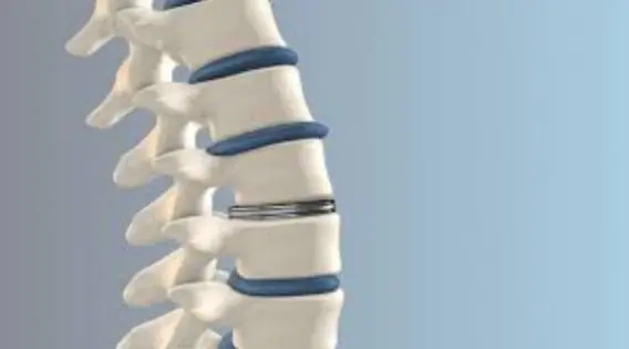 Disc Replacement Surgery in India: Contact the Best Cervical Spine Surgeon in India