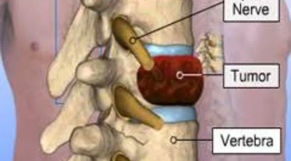 Spine Tumor Surgery in India: Consult Top Spine Neurosurgeon in Kolkata, India