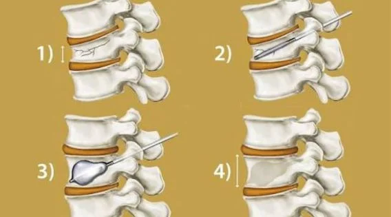Vertebroplasty and Kyphoplasty Recovery Time in the Elderly: What to Expect
