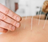 Poking Needles and Finding Balance: Exploring Acupuncture in Tulsa, OK!