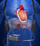 Congestive Heart Failure Treatment Devices Market: Growing Demand for Advanced Cardiac Implants