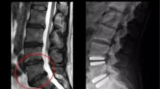 Disc Replacement India: Consult the Best Cervical Spine Surgeon in India