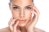 Hyperpigmentation Disorders Treatment Market Advancement Established in Healthcare System Stated Industry