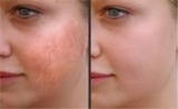 Keloid Treatment Market Insights and Therapeutic Assessment 2019