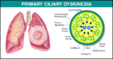 Primary ciliary dyskinesia (PCD) Market Global Trends, Key Players Analysis, Growth Factors