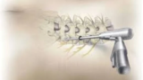 Spine Surgery in India: Quick Recovery in Minimally Invasive Spine Surgery