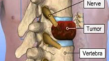 Spine Tumor Surgery in India: Consult Top Spine Neurosurgeon in Kolkata, India
