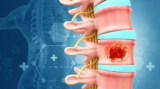 Spine Tumor Surgery in India: Meet the Top Spine Specialist in India