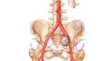 Spine Tumor Treatment by Spine Neurosurgeon in India: Advanced Care