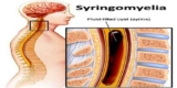 Syringomyelia Market in-Depth Analysis of Changing Dynamics by Application and Research Report