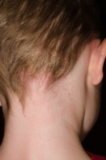 Tinea Corporis Market Growing Technology, Trends by Major Manufacturers