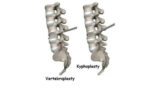 Vertebroplasty and Kyphoplasty Recovery Time in the Elderly: Consult a Top Spine Surgeon in India, Kolkata
