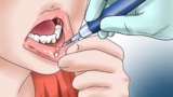 Cách chữa trị nhiệt miệng nhanh chóng