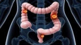 Colorectal Cancer Market Insights on Diagnosis, New Treatment Adaptations and Management