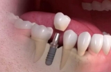Dental Implant Surgery Vs. Traditional Dentures: Which Is Right For You?