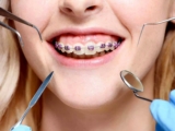Perfecting Your Smile: How Veneers Can Change Your Life