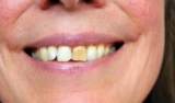 How to Get rid of Discolored Teeth?