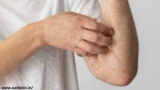 Fungal infections: Symptoms, types, and treatment
