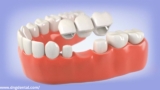 Tooth Crown And Bridges Treatment In jaipur  | Best Dental Clinic Jaipur